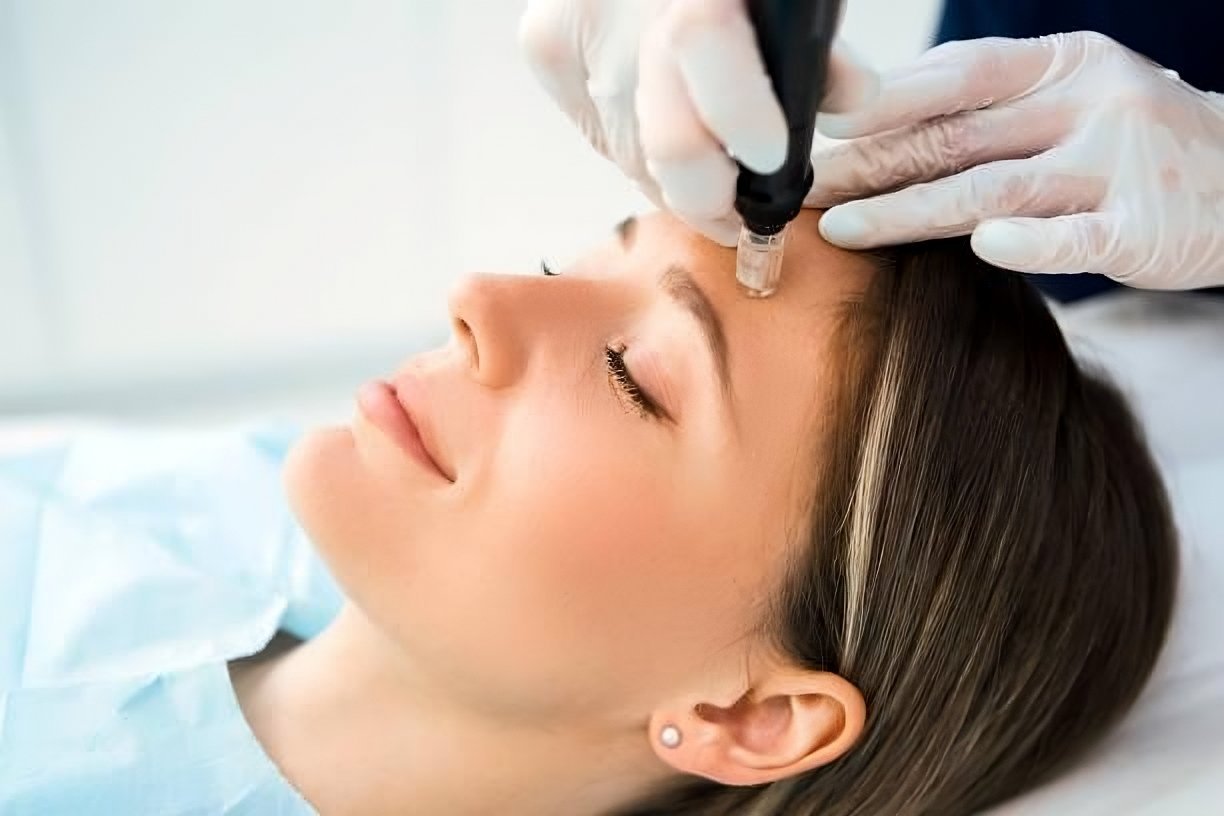 Microneedling collagen induction treatment