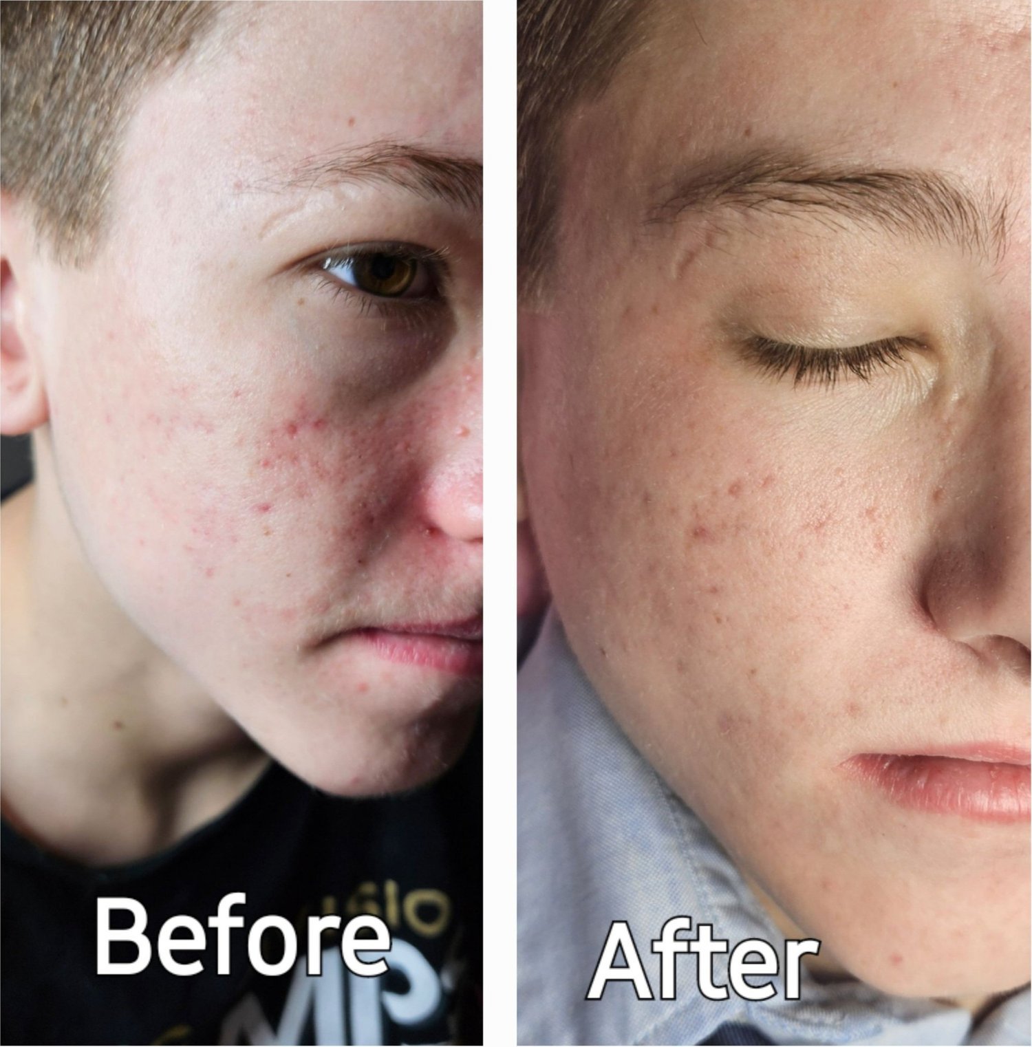 Before and after a series of facials, showing calmer, clearer skin