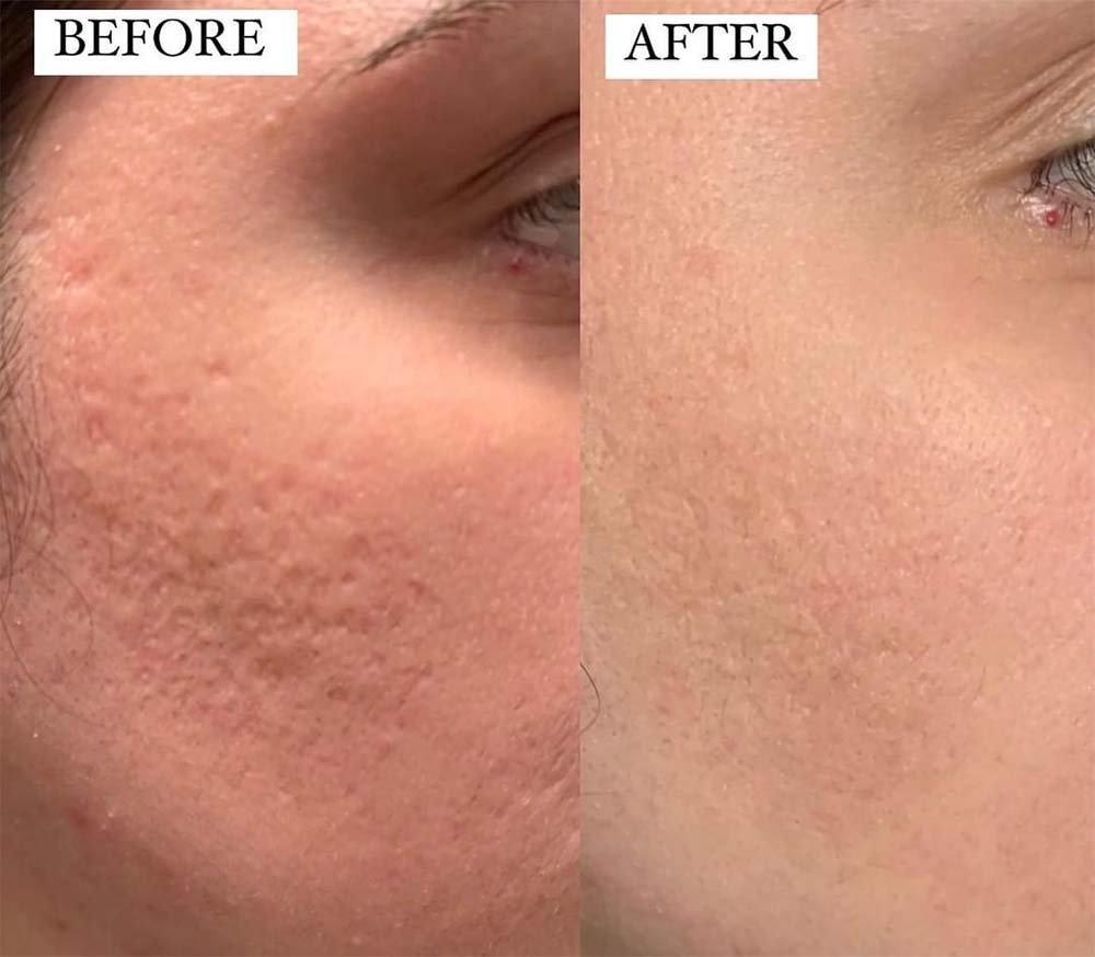 Before and after microneedling, showing smoother texture